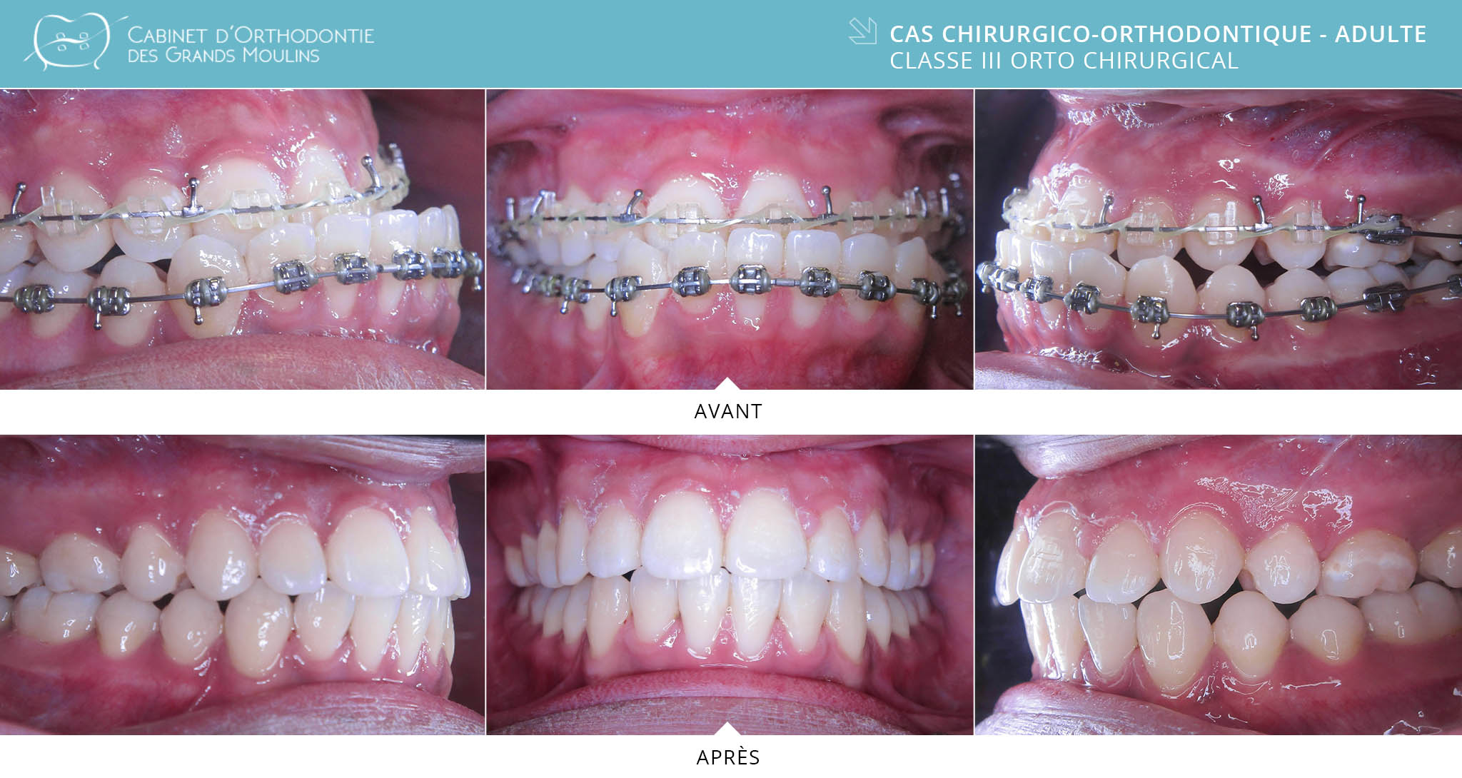 ORTHODONTIE DE L'ADULTE : TECHNIQUE PAR ALIGNEURS (GOUTTIÈRES