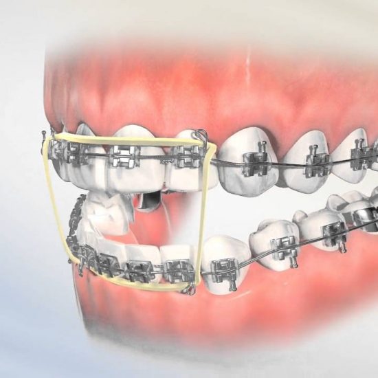 Lot De 10 Fils D'arc Orthodontiques NITI Super élastiques Forme Rectangulaire Ovoïde